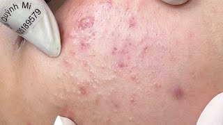 ACNE TREATMENT VU QUYNH MI Acne On Boys Chin 2024 [upl. by Korwun518]