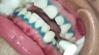 Blanqueamiento dental fácil y seguro Consejos esenciales [upl. by Christina922]