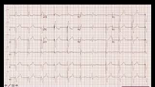 Basics Of Pacemakers 2 Dr Lamia Alshanqiti [upl. by Delfine]