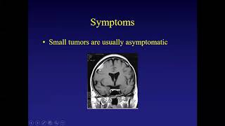 Which Meningiomas Should Not Be Treated [upl. by Taran]