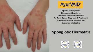 Significant Recovery from Spongiotic Dermatitis Eczema AyurVAID Hospital Domlur Bangalore [upl. by Aydin]