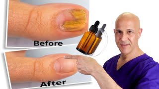 1 Oil Cures Toe Nail Fungus  Dr Mandell [upl. by Esinyt]