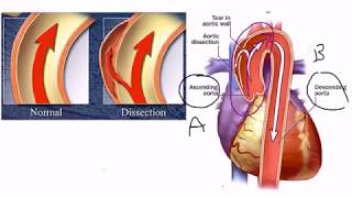 Aortic Dissection [upl. by Issac]