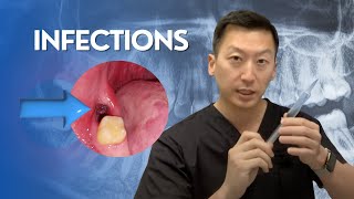 Infections after Wisdom Teeth Removal [upl. by Banquer]