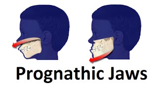 Treatment of Prognathic Jaw Jaw Pushing Forward by Prof John Mew [upl. by Jessika484]