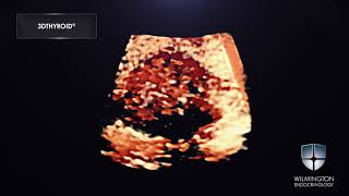 3DTHYROID® Thyroid Cancer Video Hard Nodule [upl. by Ardnosac]