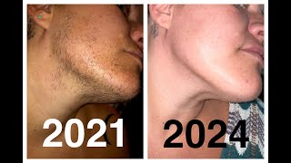 Results after 161 Hours of Electrolysis facial hair removal PCOS Hirsutism Excess Hair [upl. by Florri]