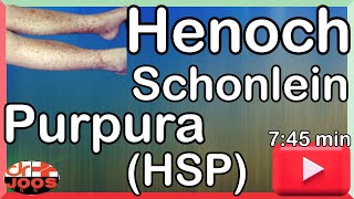 Henoch Schonlein Purpura HSP ׀ Basic necessary facts amp management ׀ Made easy  dr joos [upl. by Eelynnhoj]