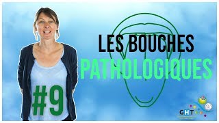 Les Bouches Pathologiques  9  Formation Hygiène BuccoDentaire [upl. by Dleifyar]