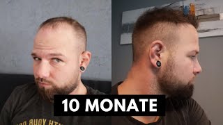 Haartransplantation 10 Monate nach der Op in einer Minute [upl. by Inalan]