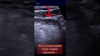 When Appendix becomes Infected and Complicated ultrasound appendicitis intestine [upl. by Olli]