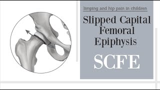 Slipped Capital Femoral Epiphysis SCFE [upl. by Zzabahs905]