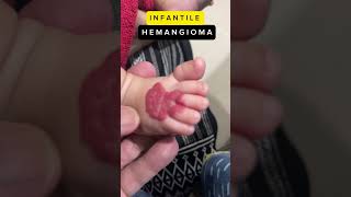 Infantile Hemangioma hemangioma infants treatment [upl. by Didier773]