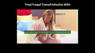 Loceryl Curanail 5 wv Medicated Nail Lacquer  Fungus Toenail Treatment Review [upl. by Claudell]