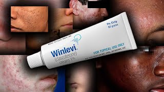 Dont use Accutane Use Winlevi for acne [upl. by Waldon]