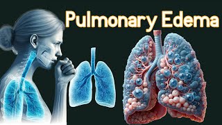 Pulmonary Edema Fluid In the Lungs Symptoms amp causes [upl. by Adla380]