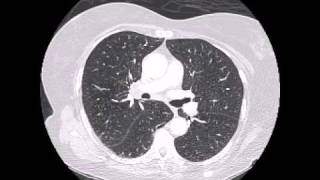 Spiculated lung tumor in background of emphysema [upl. by Tabatha]