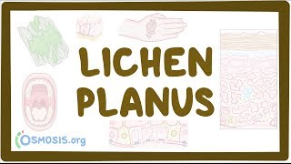 Lichen planus  causes symptoms diagnosis treatment pathology [upl. by Cogn]