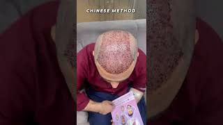 Chinese Method 8000 Grafts before amp after result of hair transplant 😎👍 [upl. by Keare]