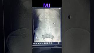 Intra venous urogram  pyelogram  radiological xray medicalimaging doctor anatomy [upl. by Tsenrae449]