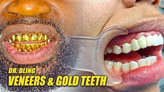 Veneers Procedure Replacing Gold Teeth With Veneers  Adding More Gold Teeth [upl. by Enitsyrhc]