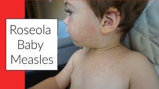 ROSEOLA  BABY MEASLES  SIGNS amp SYMPTOMS  RASH [upl. by Aynatahs]