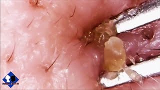 Blackheads Removal Close up part11 [upl. by Tnemelc967]