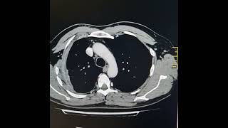 Small hydropneumothorax on right side with pleural cortication [upl. by Jamnis211]