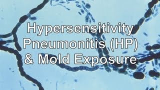 Hypersensitivity Pneumonitis amp Mold Exposure [upl. by Anahcar]