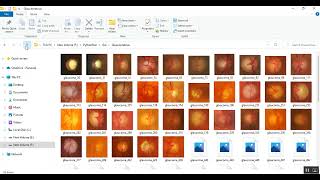 Fuzzy acceptance Analysis of Impact of Glaucoma and Diabetic Retinopathy using Confusion Matrix [upl. by Miru]