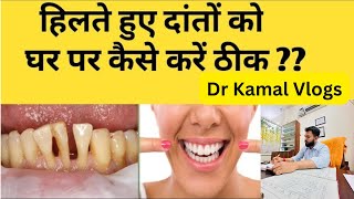 Tooth Mobility Treatment  दांत हिलने के लक्षण कारण इलाज  Loose Tooth  Dr Kamal Baliwan [upl. by Ybok]