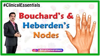 Bouchard’s and Heberden’s nodes  Clinical essentials [upl. by Camellia]