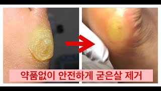 굳은살 제거  레푸스 원주점 Removing dead skin cells of the foot [upl. by Eramal579]