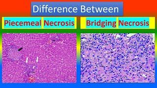 Difference between Piecemeal Necrosis and Bridging Necrosis [upl. by Boesch637]