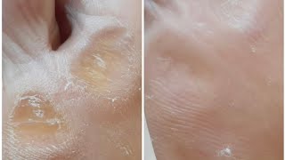 Calluses and corns Remove treatmentsatisfying footcomfort footcare footcallous foot skin [upl. by Worl]