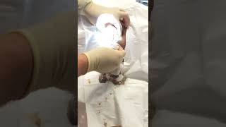 Exploding grapefruit sized sebaceous cyst popping [upl. by Noreik365]