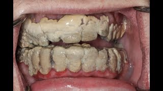 20 Years Without Brushing Teeth 😦  Calculus Removal [upl. by Ydnat]