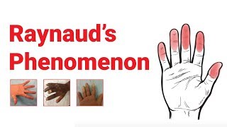 Raynaud’s Phenomenon  What You Should Know  Johns Hopkins Medicine [upl. by Jolda]