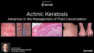 Actinic Keratosis Advances in the Management of Field Cancerization [upl. by Gala]