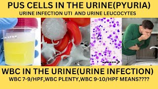 PUS CELLS IN THE URINEPYURIAWBC IN THE URINEURINE LEUCOCYTES CAUSES SYMPTOMS AND TREATMENT [upl. by Mcclees]