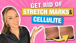 How to Get Rid of Stretch Marks amp Cellulite from a Dermatologist  Dr Shereene Idriss [upl. by Gyasi308]