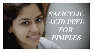 Salicylic Acid Peel For Pimplesdranvikacom [upl. by Nauqad]