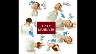 EPLEY MANEUVER  Canalith Repositioning Procedure CRP  Treatment of BPPVHow to do Epley maneuver [upl. by Maxie]