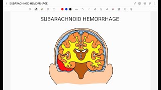 SUBARACHNOID HEMORRHAGE [upl. by Gio]