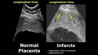 Placenta Ultrasound Normal Vs Abnormal Image Appearances Comparison  Placental Pathologies on USG [upl. by Kally965]