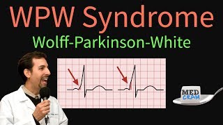 WPW  WolffParkinsonWhite Syndrome ECG  EKG findings symptoms pathology amp treatment [upl. by Jamel195]