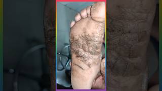 पैरो के तलवे की चमडी का रोग plantar keratoderma viralshorts [upl. by Waine]