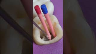 Restoration of Tooth toothcavity shorts [upl. by Soinski]