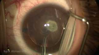 Pediatric posterior lenticonus cataract posterior capsulorhexis with optic capture toric IOL [upl. by Sirred]