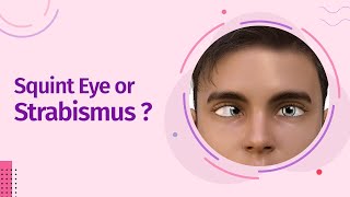 What is Squint Eye or Strabismus What Causes it [upl. by Slade]